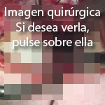 Plicatura capsular